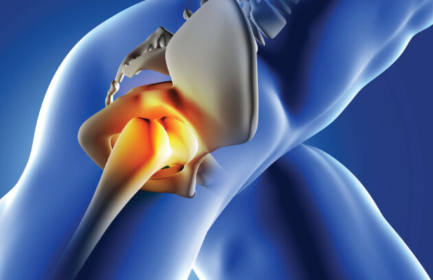 Hip Replacement in Ahmedabad