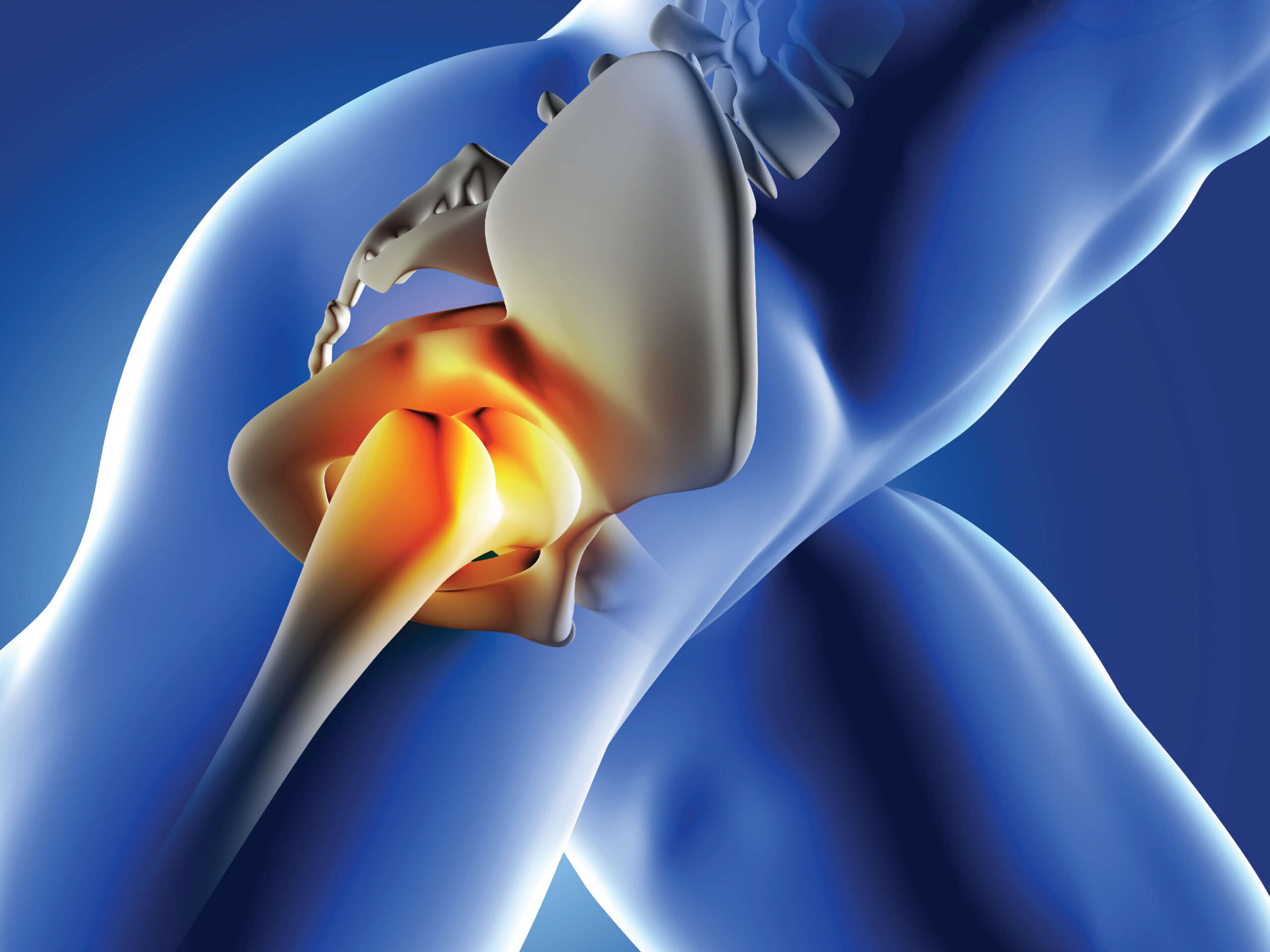 Hip Replacement in Ahmedabad