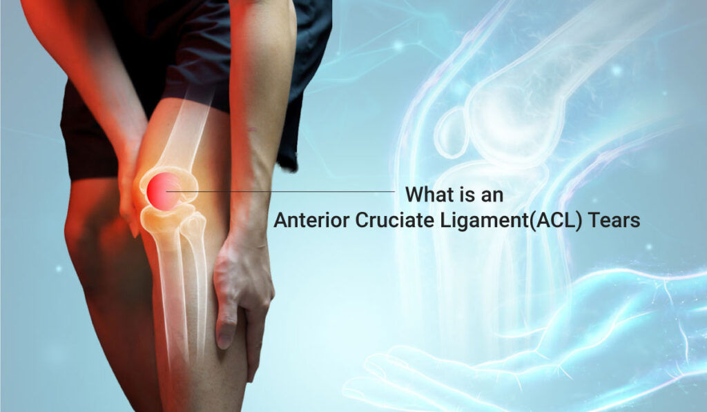 Anterior Cruciate Ligament(ACL) Tears