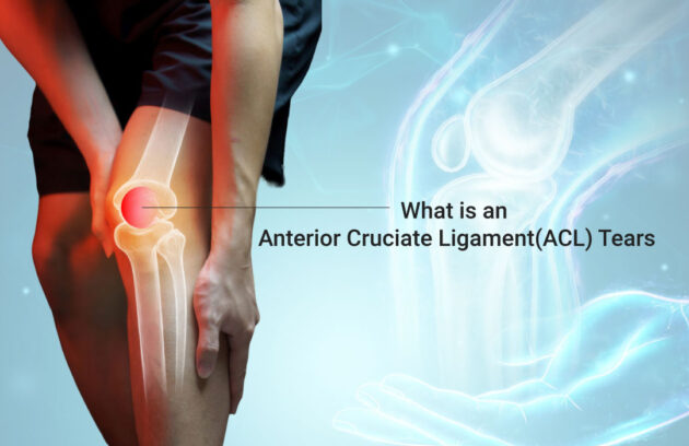 Anterior Cruciate Ligament(ACL) Tears