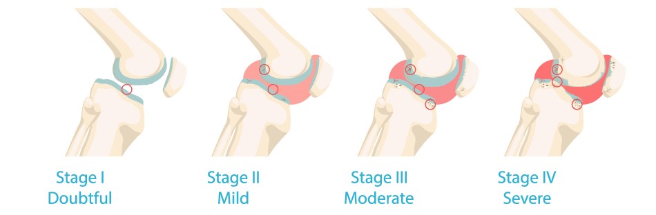 Several stages of Osteoarthritis