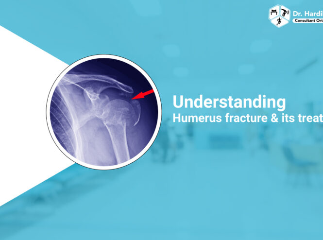 Understanding humerus fracture and its treatment