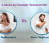 a guide to shoulder replacement- total or partial