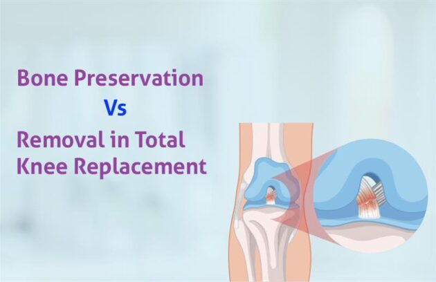 bone preservation vs. removal