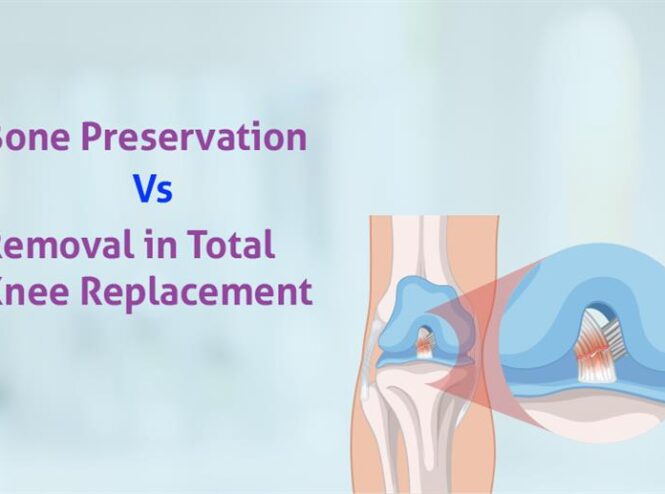 bone preservation vs. removal