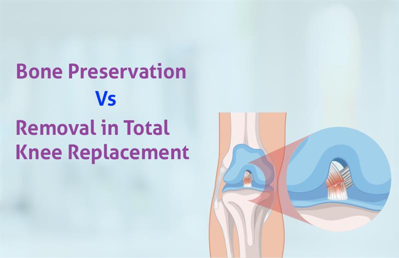 bone preservation vs. removal