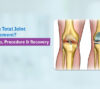 Total Joint Replacement