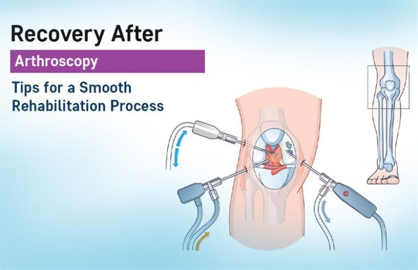 arthroscopy recovery